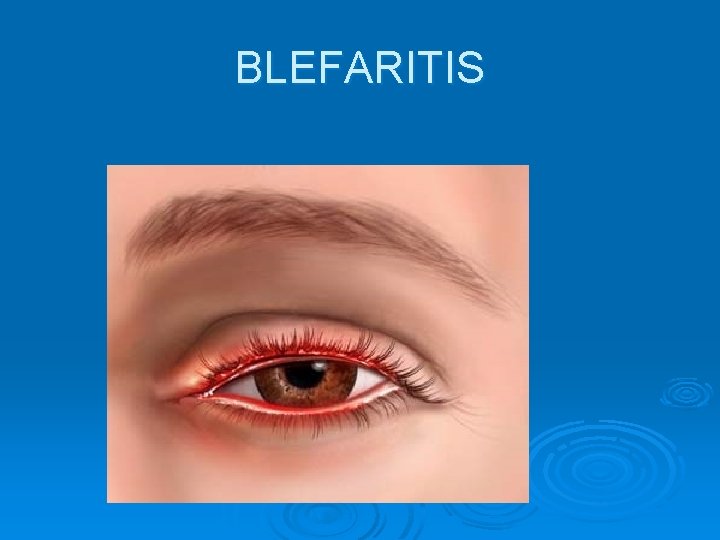 BLEFARITIS 