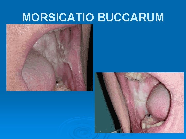 MORSICATIO BUCCARUM 