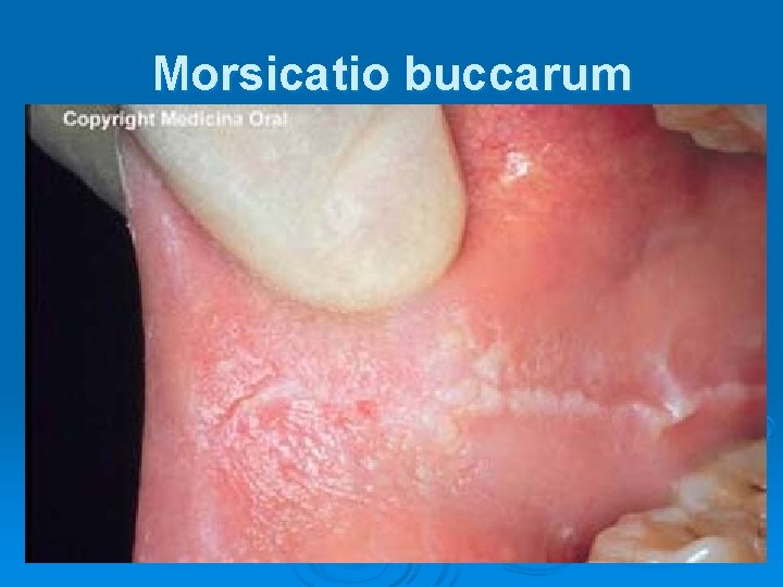 Morsicatio buccarum 