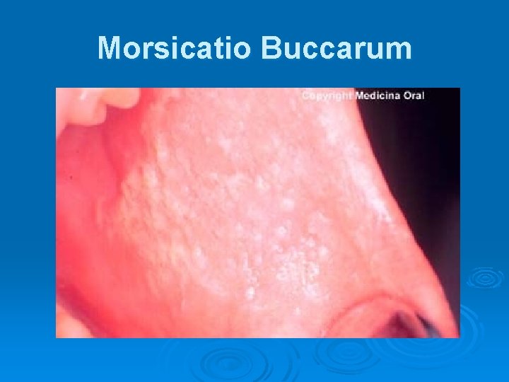 Morsicatio Buccarum 