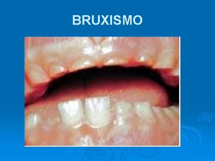 BRUXISMO 