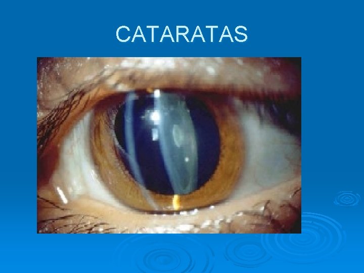 CATARATAS 