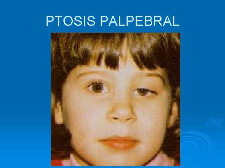 PTOSIS PALPEBRAL 