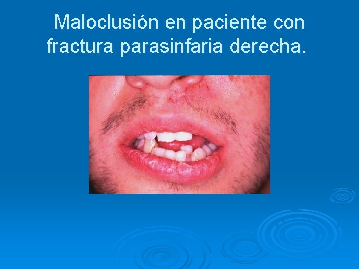 Maloclusión en paciente con fractura parasinfaria derecha. 