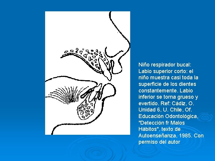 Niño respirador bucal: Labio superior corto: el niño muestra casi toda la superficie de