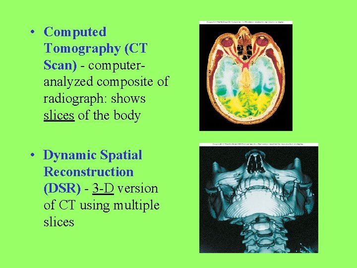  • Computed Tomography (CT Scan) - computeranalyzed composite of radiograph: shows slices of