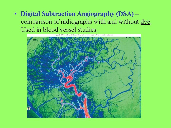 • Digital Subtraction Angiography (DSA) – comparison of radiographs with and without dye.