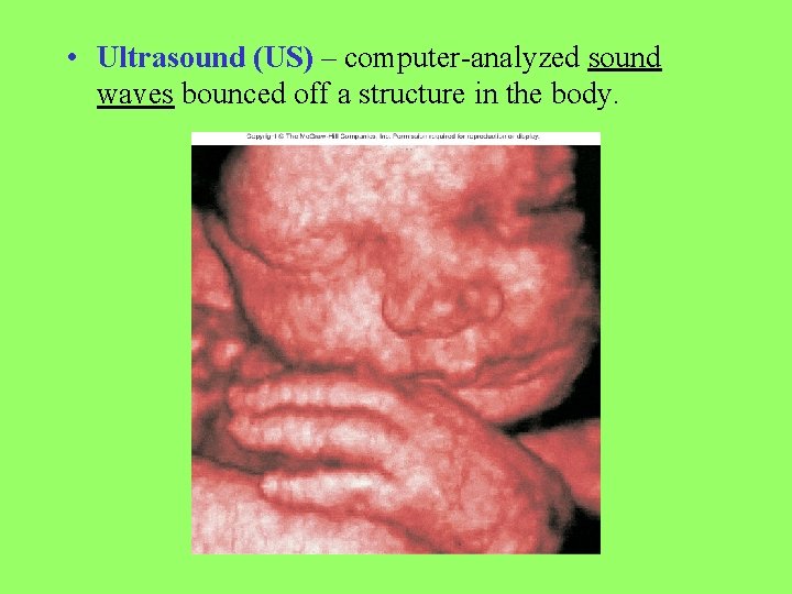  • Ultrasound (US) – computer-analyzed sound waves bounced off a structure in the