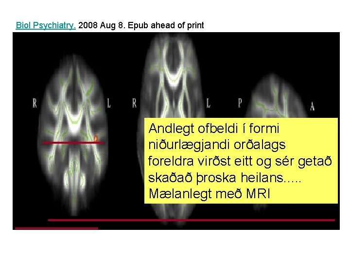 Biol Psychiatry. 2008 Aug 8. Epub ahead of print Andlegt ofbeldi í formi niðurlægjandi