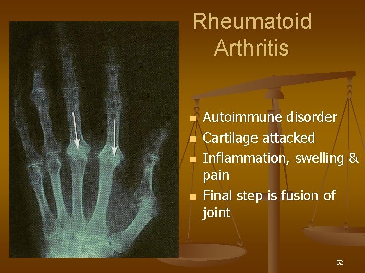Rheumatoid Arthritis n n Autoimmune disorder Cartilage attacked Inflammation, swelling & pain Final step
