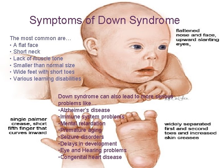 + Symptoms of Down Syndrome The most common are… • A flat face •