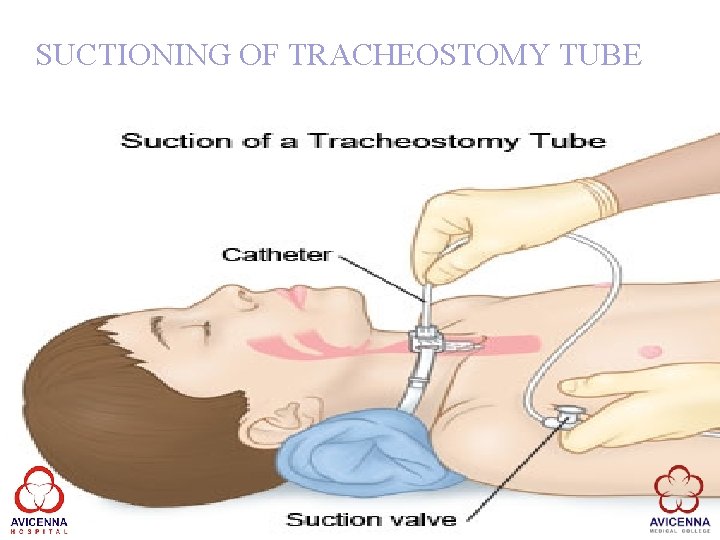 SUCTIONING OF TRACHEOSTOMY TUBE 