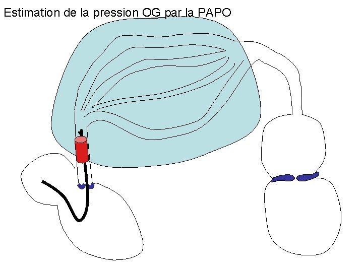 Estimation de la pression OG par la PAPO 