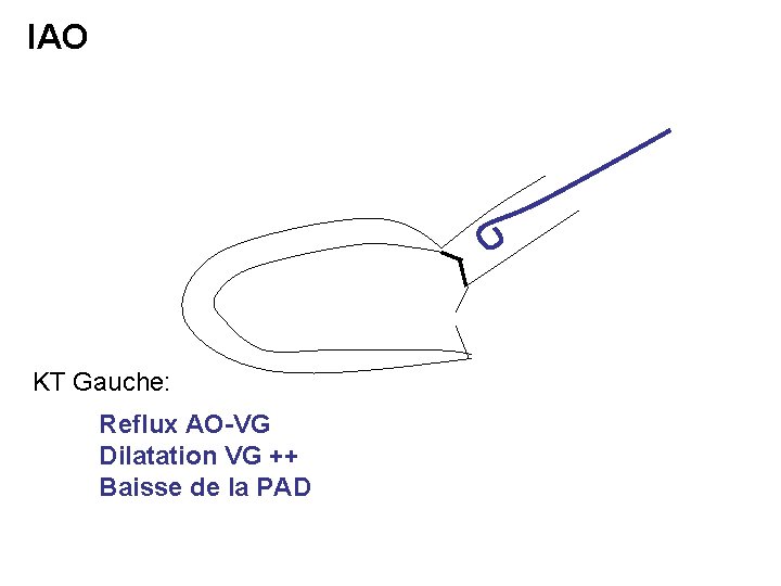 IAO KT Gauche: Reflux AO-VG Dilatation VG ++ Baisse de la PAD 