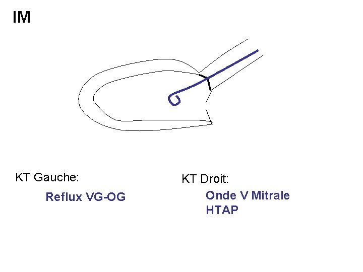 IM KT Gauche: Reflux VG-OG KT Droit: Onde V Mitrale HTAP 