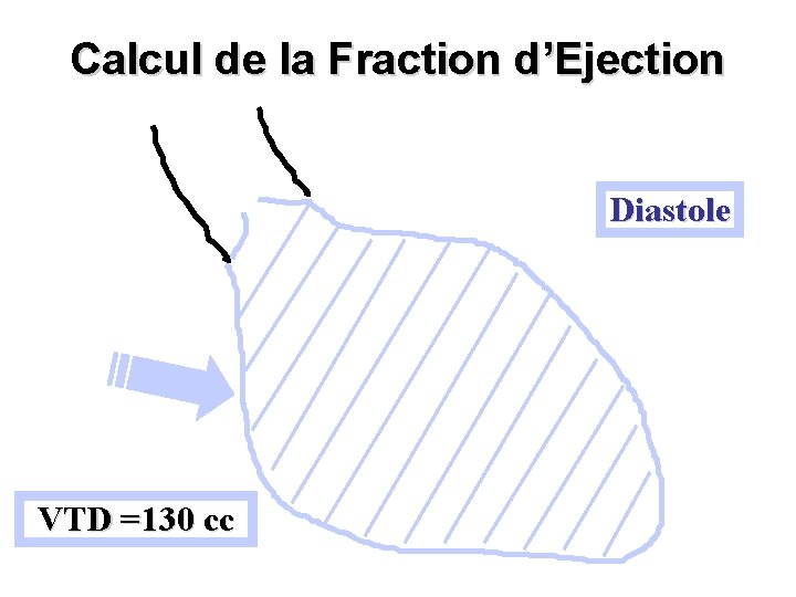 Calcul de la Fraction d’Ejection Diastole VTD =130 cc 