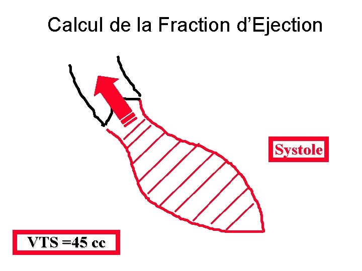 Calcul de la Fraction d’Ejection Systole VTS =45 cc 