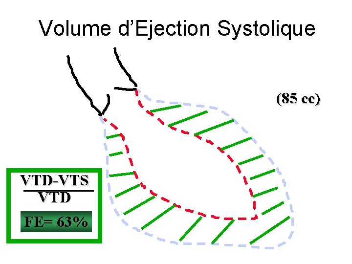 Volume d’Ejection Systolique (85 cc) VTD-VTS VTD FE= 63% 