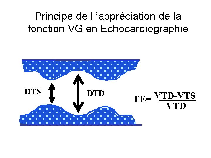 Principe de l ’appréciation de la fonction VG en Echocardiographie DTS DTD FE= VTD-VTS