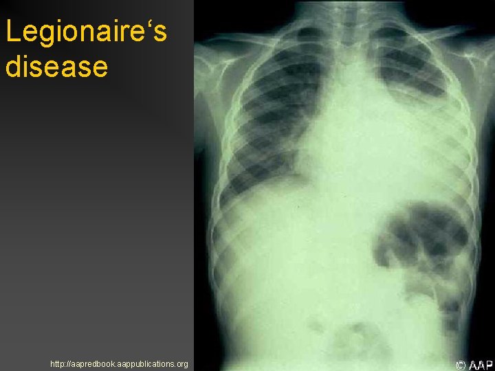 Legionaire‘s disease http: //aapredbook. aappublications. org 