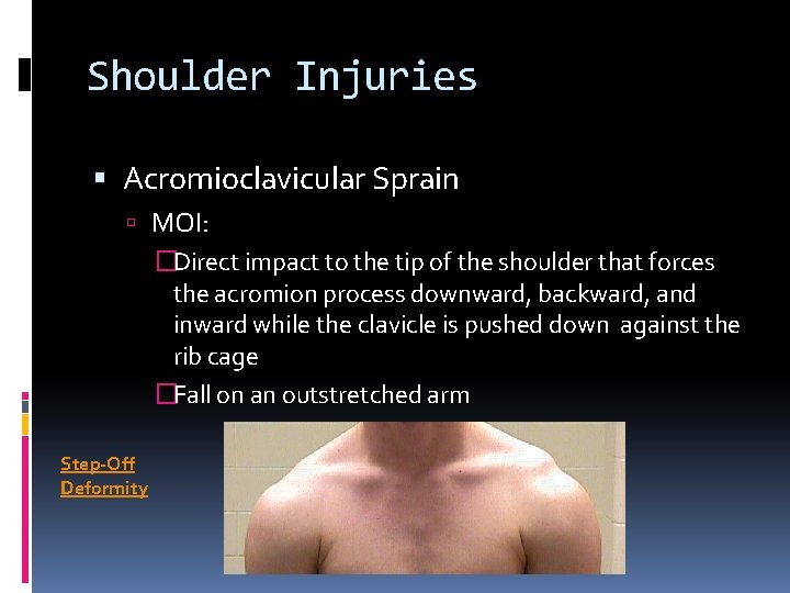 Shoulder Injuries Acromioclavicular Sprain MOI: �Direct impact to the tip of the shoulder that