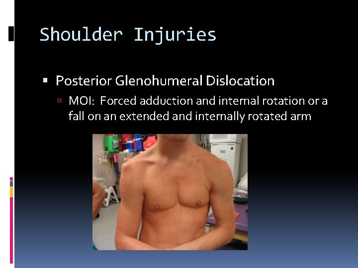 Shoulder Injuries Posterior Glenohumeral Dislocation MOI: Forced adduction and internal rotation or a fall