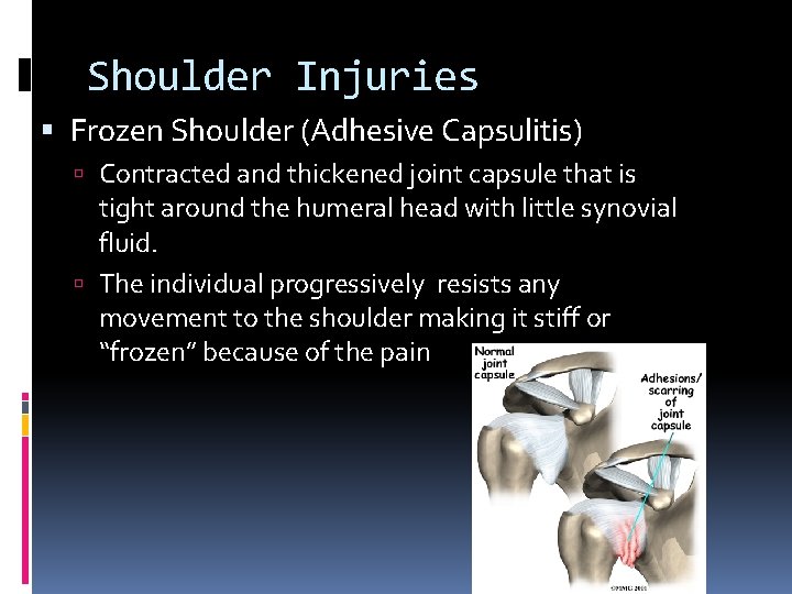 Shoulder Injuries Frozen Shoulder (Adhesive Capsulitis) Contracted and thickened joint capsule that is tight