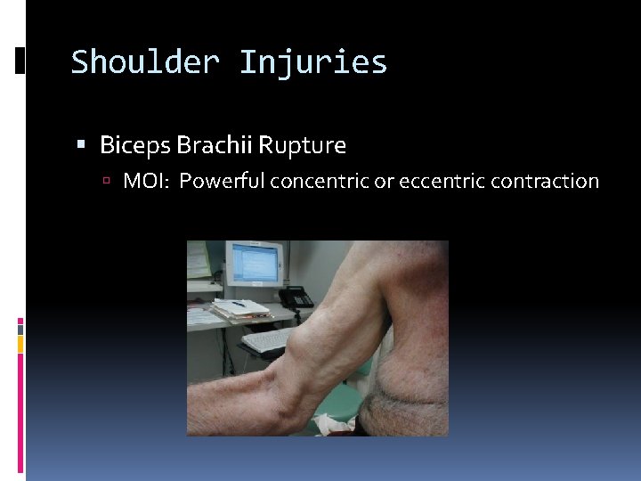 Shoulder Injuries Biceps Brachii Rupture MOI: Powerful concentric or eccentric contraction 
