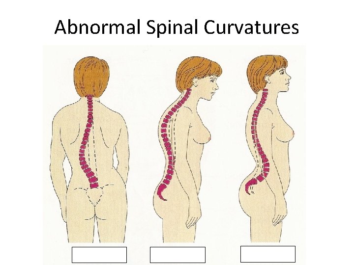 Abnormal Spinal Curvatures 