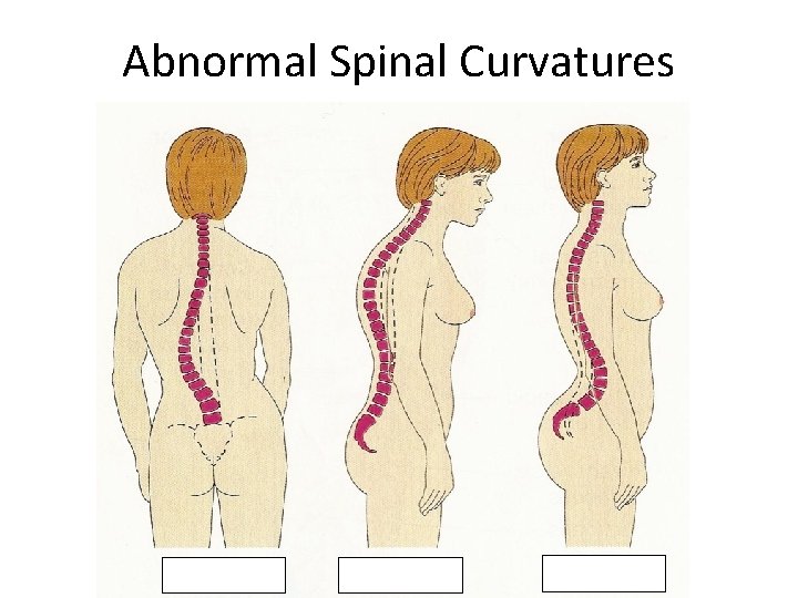 Abnormal Spinal Curvatures Abnormal Spinal Curvatures