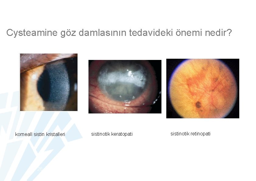 Cysteamine göz damlasının tedavideki önemi nedir? korneall sistin kristalleri 26 sistinotik keratopati sistinotik retinopati