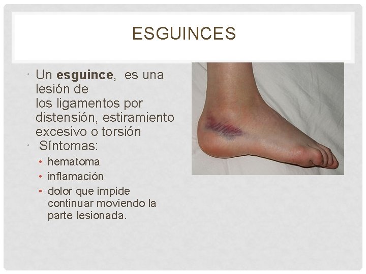 ESGUINCES Un esguince, es una lesión de los ligamentos por distensión, estiramiento excesivo o