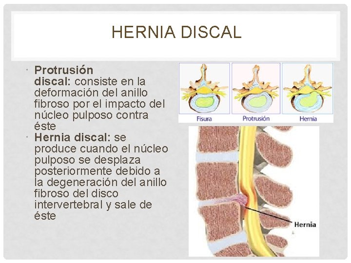 HERNIA DISCAL Protrusión discal: consiste en la deformación del anillo fibroso por el impacto