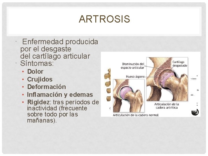 ARTROSIS Enfermedad producida por el desgaste del cartílago articular Síntomas: • • • Dolor