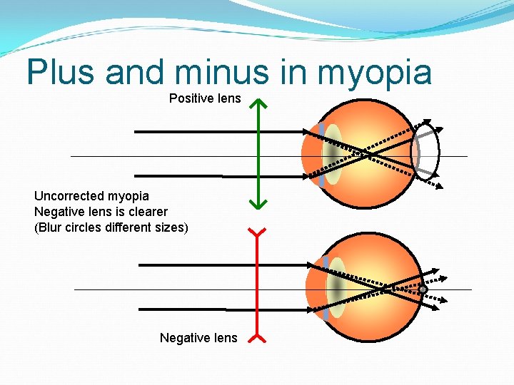 Plus and minus in myopia Positive lens Uncorrected myopia Negative lens is clearer (Blur