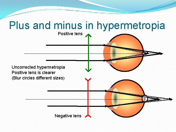 Plus and minus in hypermetropia Positive lens Uncorrected hypermetropia Positive lens is clearer (Blur