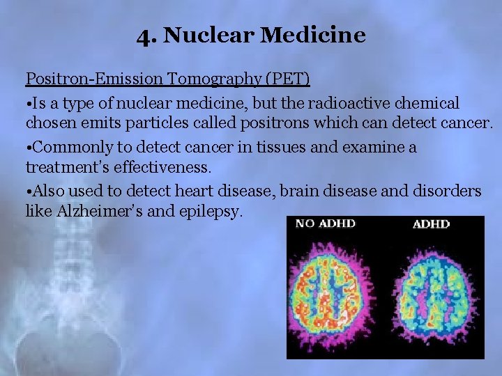 4. Nuclear Medicine Positron-Emission Tomography (PET) • Is a type of nuclear medicine, but