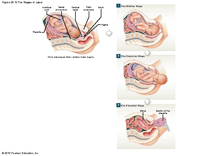 Figure 28. 10 The Stages of Labor Umbilical cord Sacral promontory Cervical canal Pubic