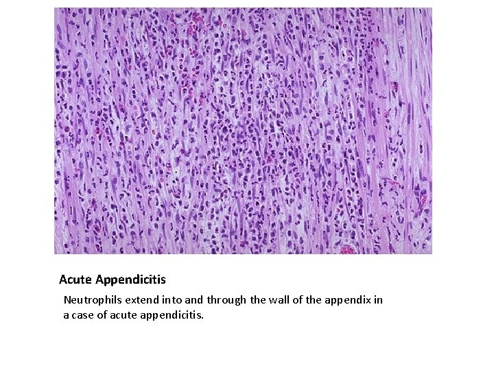 Acute Appendicitis Neutrophils extend into and through the wall of the appendix in a