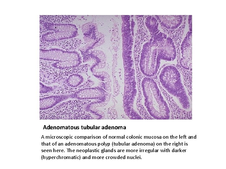 Adenomatous tubular adenoma A microscopic comparison of normal colonic mucosa on the left and