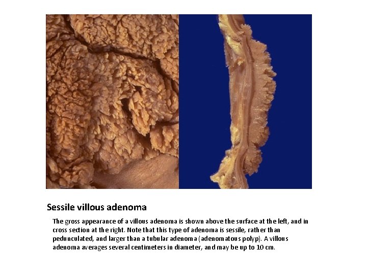 Sessile villous adenoma The gross appearance of a villous adenoma is shown above the