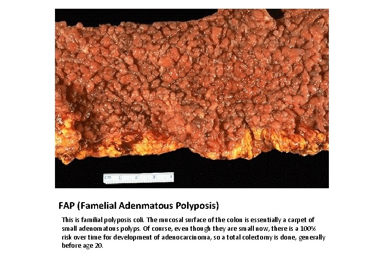 FAP (Famelial Adenmatous Polyposis) This is familial polyposis coli. The mucosal surface of the