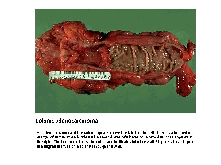 Colonic adenocarcinoma An adenocarcinoma of the colon appears above the label at the left.