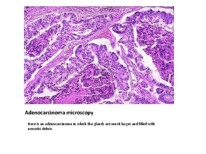Adenocarcinoma microscopy Here is an adenocarcinoma in which the glands are much larger and