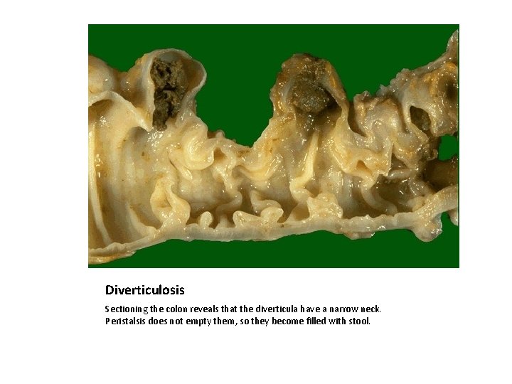Diverticulosis Sectioning the colon reveals that the diverticula have a narrow neck. Peristalsis does