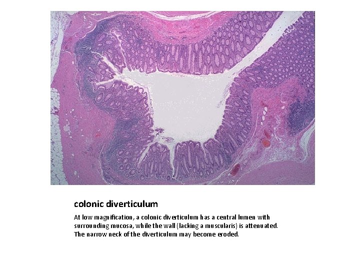 colonic diverticulum At low magnification, a colonic diverticulum has a central lumen with surrounding