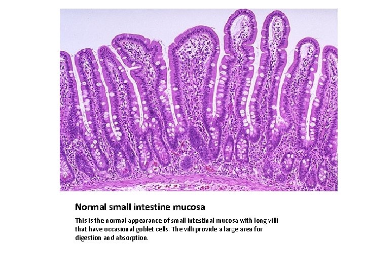 Normal small intestine mucosa This is the normal appearance of small intestinal mucosa with