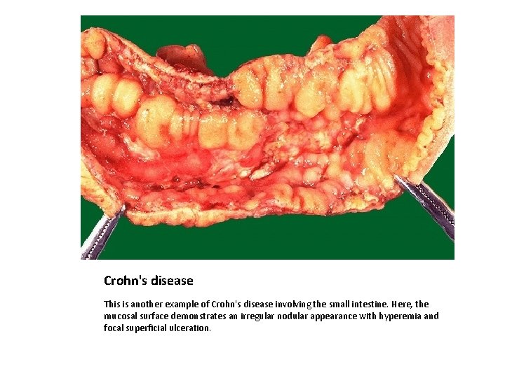 Crohn's disease This is another example of Crohn's disease involving the small intestine. Here,