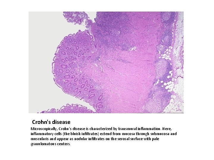 Crohn's disease Microscopically, Crohn's disease is characterized by transmural inflammation. Here, inflammatory cells (the