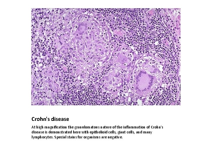 Crohn's disease At high magnification the granulomatous nature of the inflammation of Crohn's disease